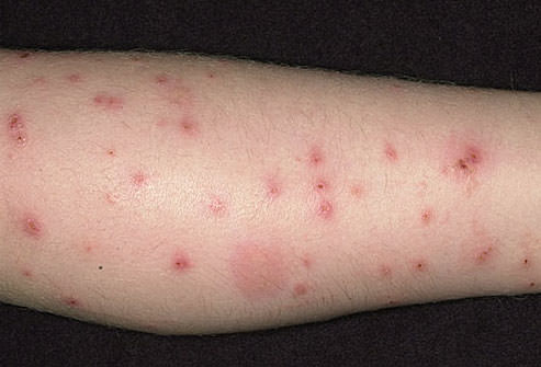 Best-Bed-Bugs-Picaduras